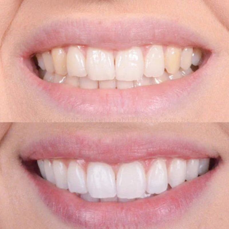 Blanqueamiento dental rápido para una sonrisa brillante