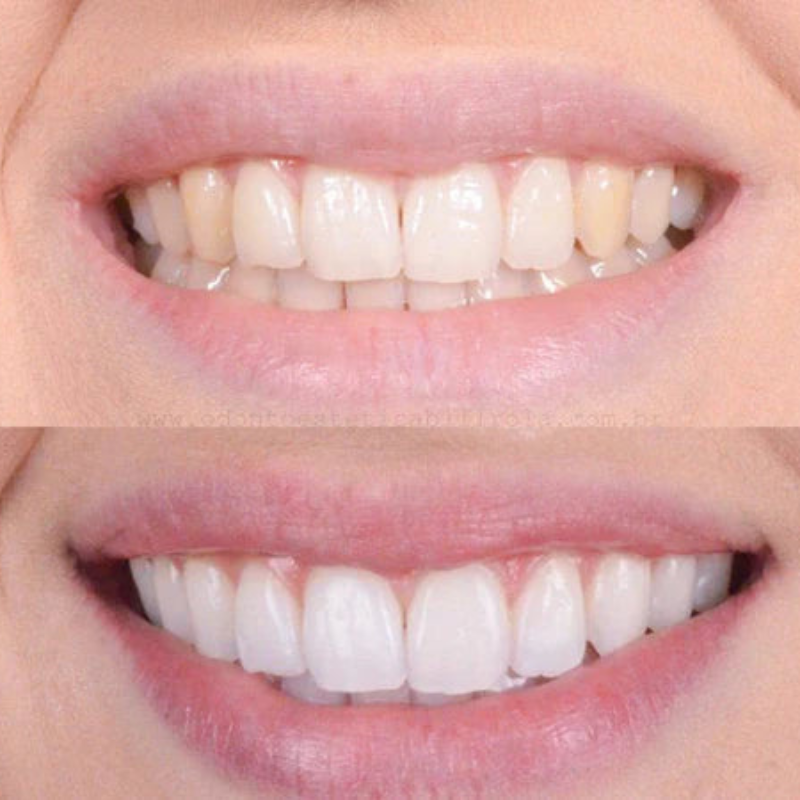 Branqueamento dental rápido para um sorriso radiante 